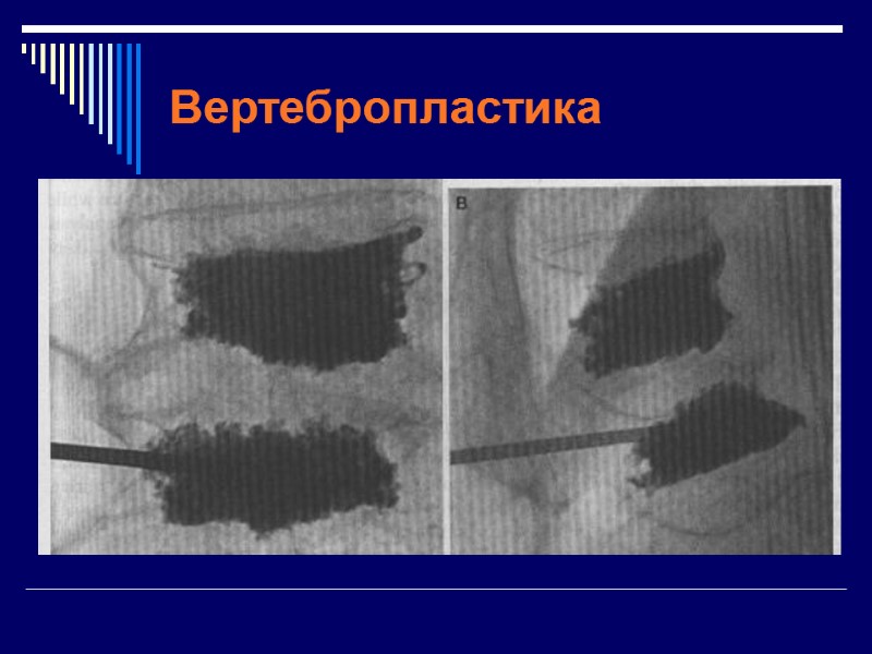 Вертебропластика